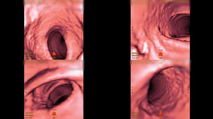 CT结肠造影