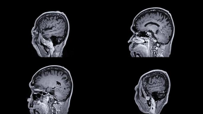 用钆造影剂对大脑进行MRI。