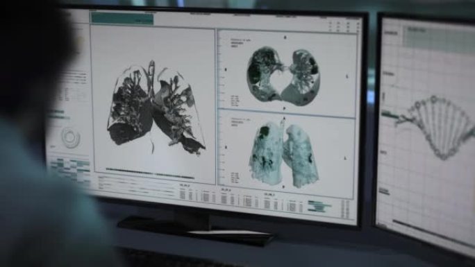 在计算机上评估ct扫描报告中显示的新型冠状病毒肺炎肺损伤水平