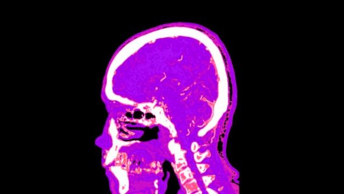 彩色模式的大脑ct扫描或PET ct扫描。
