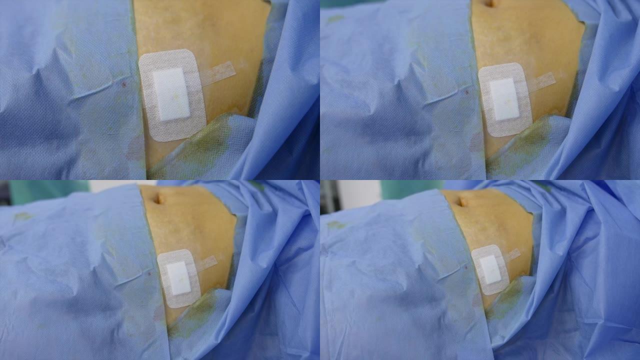在病人侧的切口上贴上胶贴。特写。病人躺在手术台上，上面覆盖着蓝色的床单。
