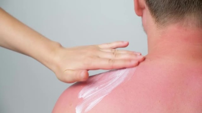 将治疗霜涂在男人皮肤上晒伤的过程。