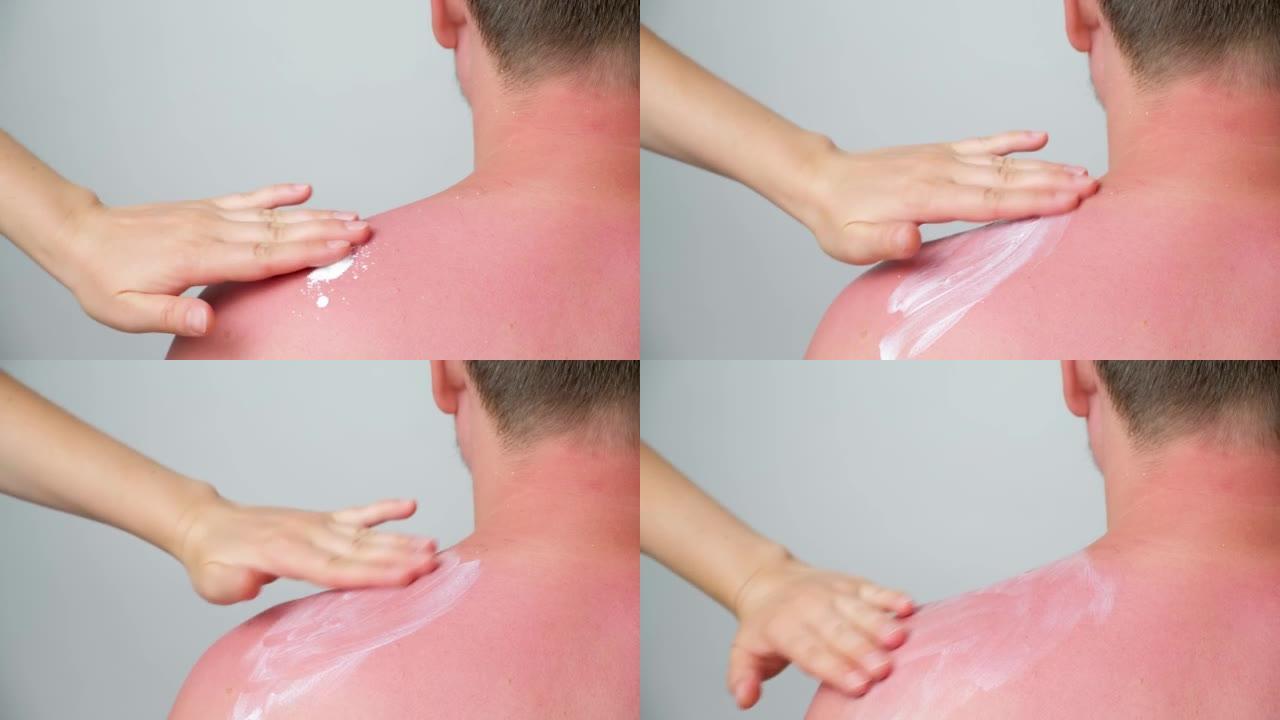将治疗霜涂在男人皮肤上晒伤的过程。
