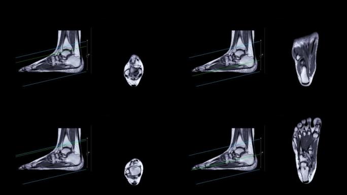 MRI足部扫描。