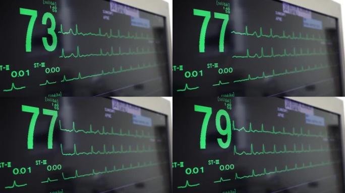 手术中的心脏体征。筛查患者心脏。生命体征监视器。心电图股票视频。