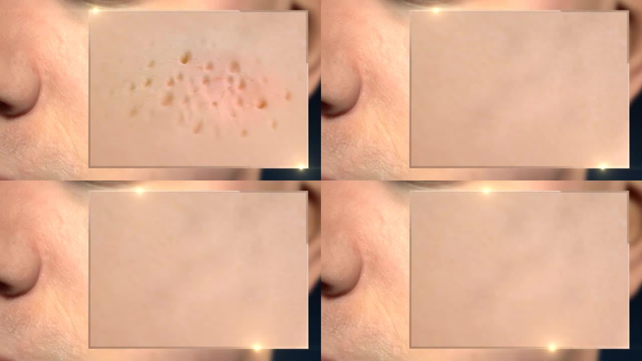 3D动画特写霜血清胶原蛋白修复效果皮肤去污。深层清洁皮肤。皮肤毛孔。痤疮清洁。皮肤毛孔清洁