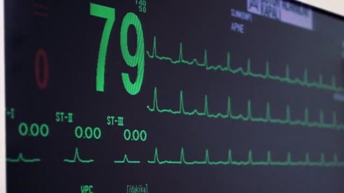手术中的心脏体征。筛查患者心脏。生命体征监视器。心电图股票视频。
