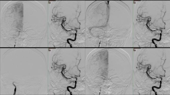 脑血管造影术。