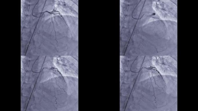 冠状动脉血管造影。