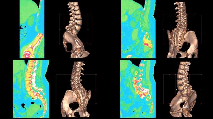 腰椎ct扫描诊断下腰痛疾病