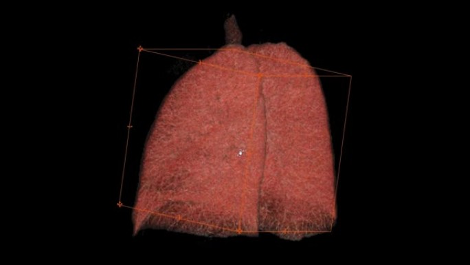 CT胸部或肺部3D渲染图像在屏幕上翻转。