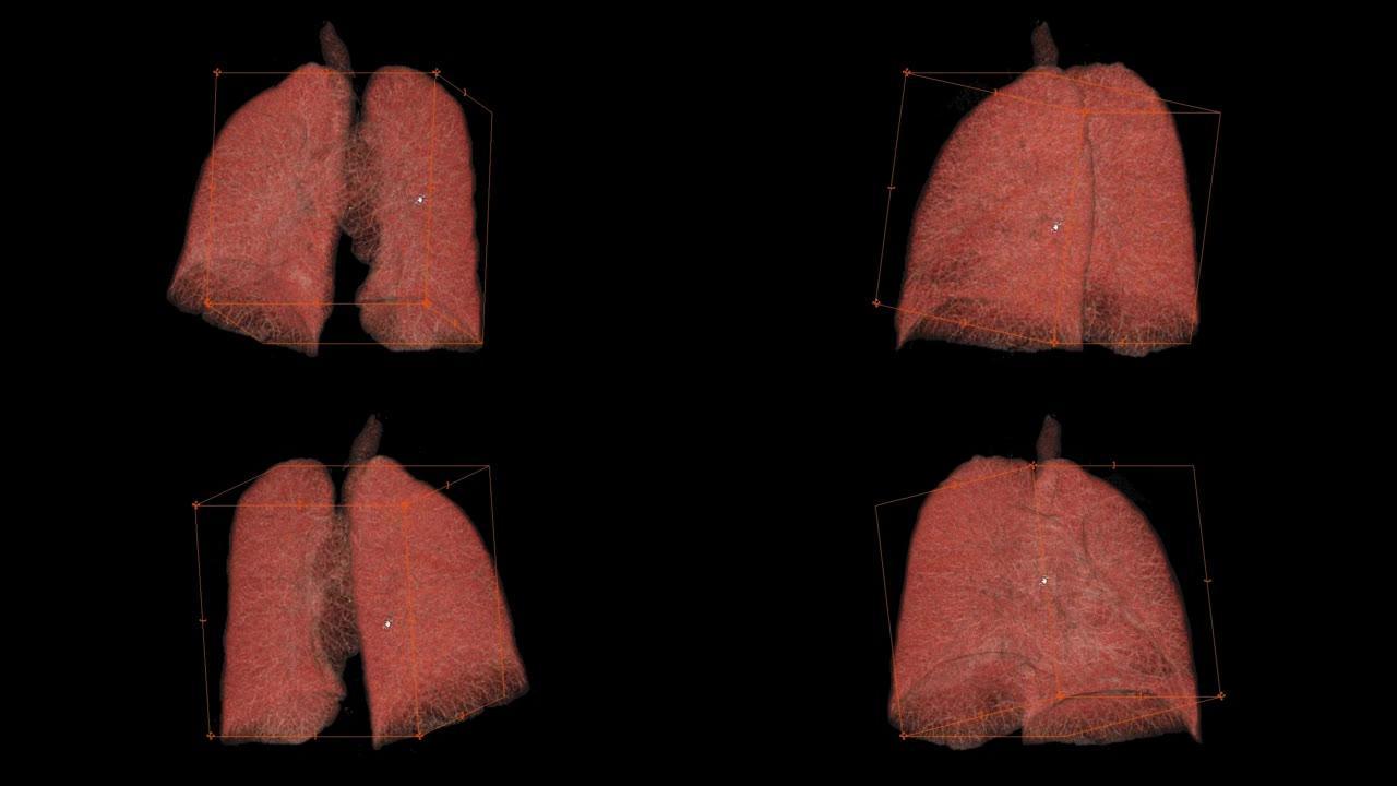 CT胸部或肺部3D渲染图像在屏幕上翻转。