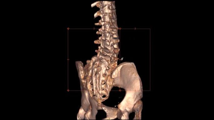 腰椎ct扫描诊断下腰痛疾病