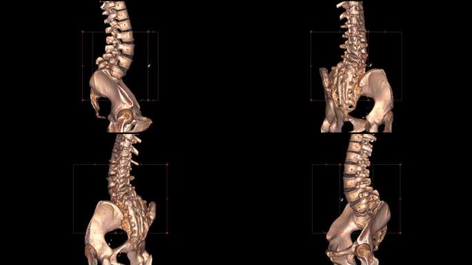 腰椎ct扫描诊断下腰痛疾病