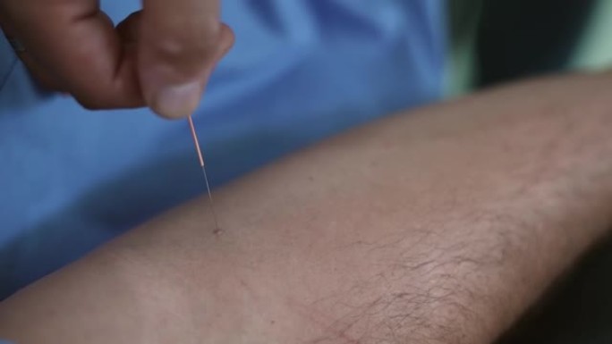 整体治疗师在水疗中心的针灸治疗中，从男人身上取出针灸针。