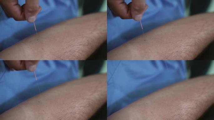 整体治疗师在水疗中心的针灸治疗中，从男人身上取出针灸针。
