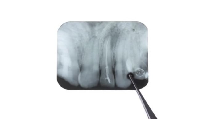 牙齿的囊肿x光。上颌神经根囊肿。病理形成，在感染，脓肿，断牙的人的牙齿x-ray.X-ray可见牙齿