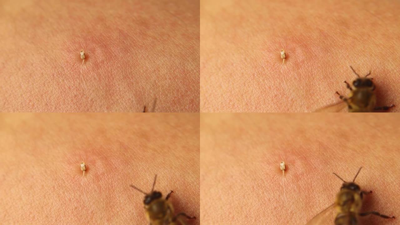 蜜蜂的毒囊。
蜜蜂刺伤了一个人的手臂。
刺痛结束后，蜜蜂离开毒液囊，注意到它仍在通过周围肌肉的压力自