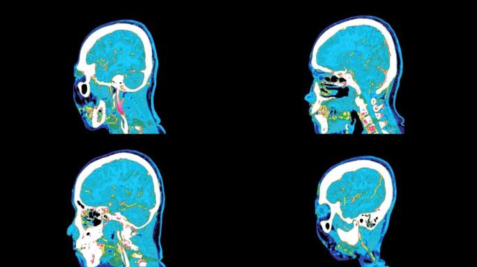 彩色模式的大脑ct扫描或PET ct扫描。