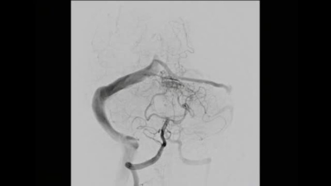 脑血管造影术。