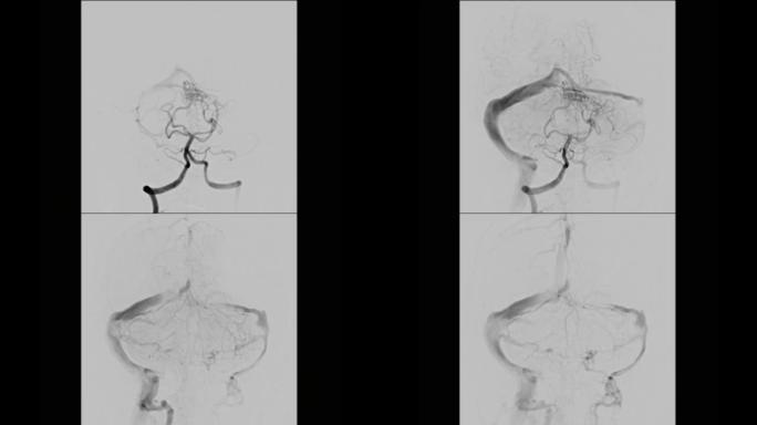 脑血管造影术。
