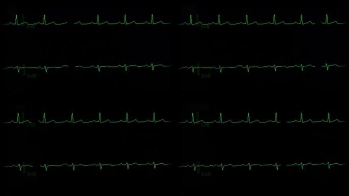 心电波形心电波形