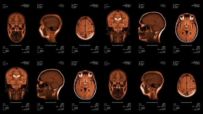 头部MRI扫描。可循环。琥珀。