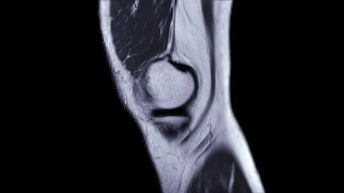 MRI膝关节。