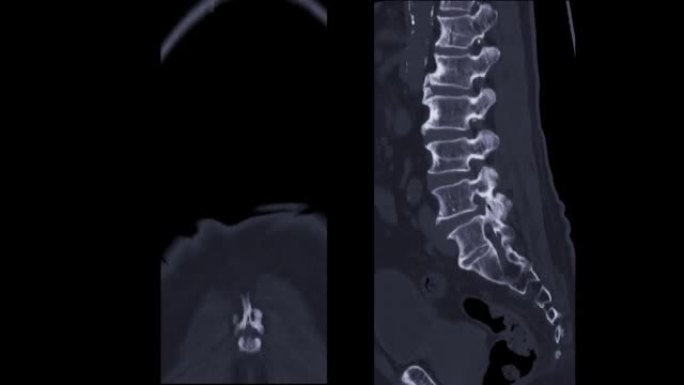 CT脊髓造影