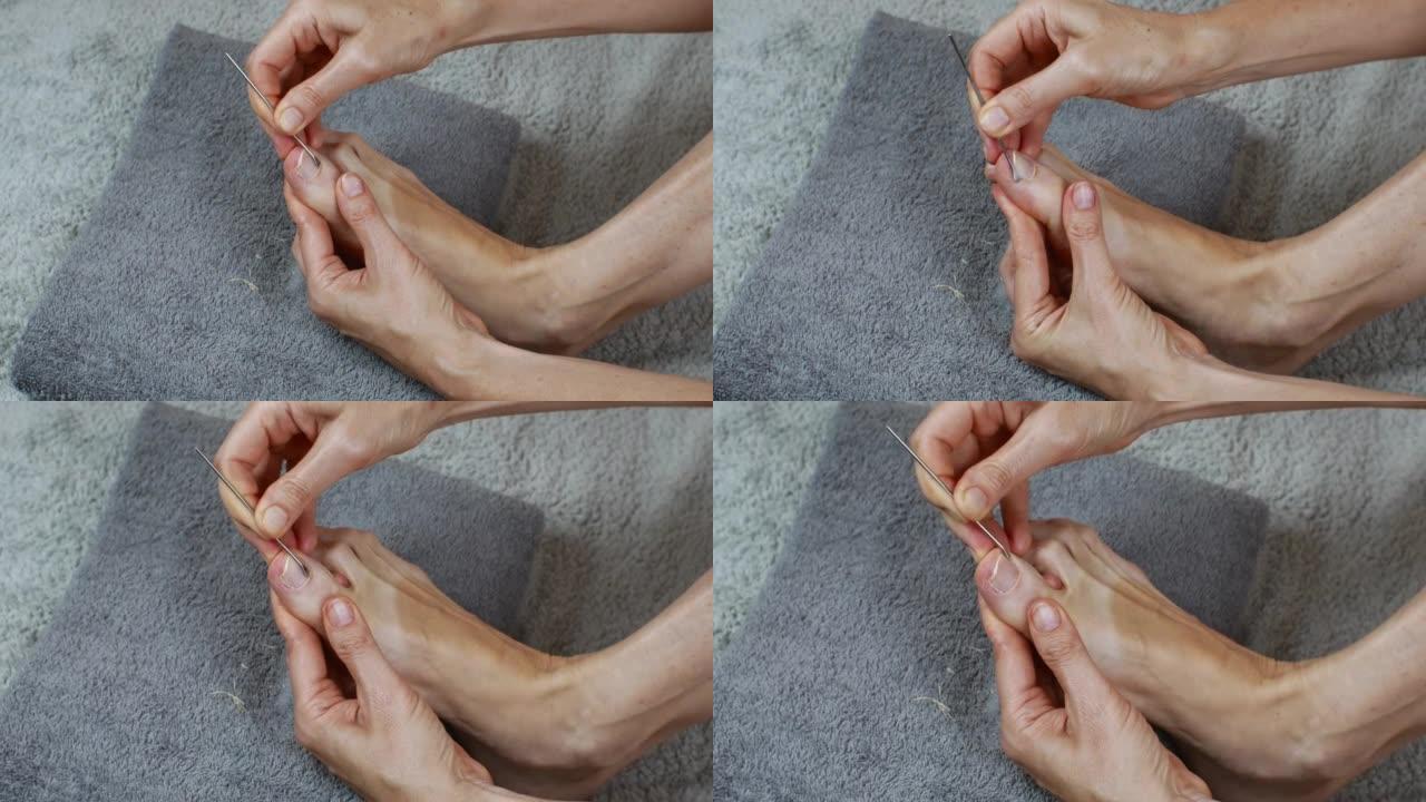 女性足部修脚的特写镜头。脚钉护理。