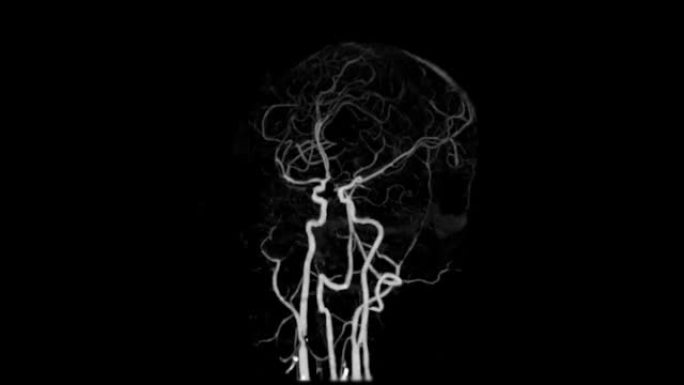 脑动脉ct血管造影术。