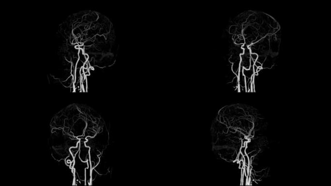 脑动脉ct血管造影术。