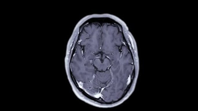 用钆造影剂对大脑进行MRI。