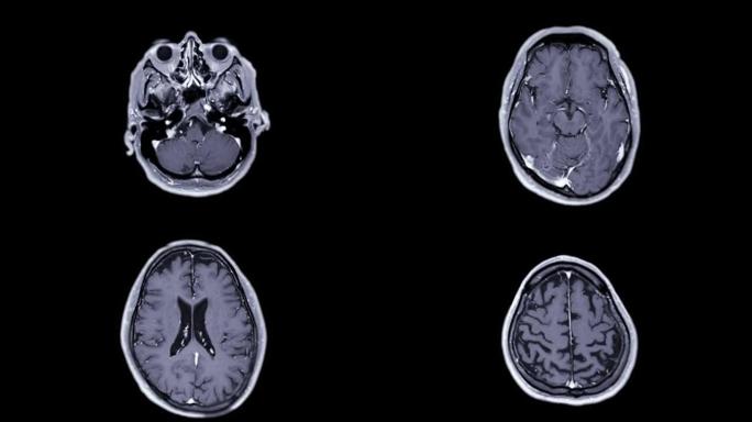 用钆造影剂对大脑进行MRI。