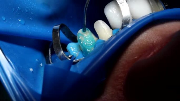 牙医在安装贴面前将蓝色凝胶涂在牙齿上特写4k电影慢动作