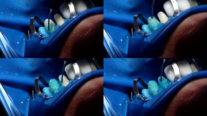 牙医在安装贴面前将蓝色凝胶涂在牙齿上特写4k电影慢动作