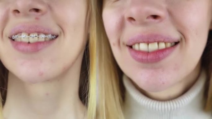 移除牙套之前和之后。左侧是金属支架系统中的女孩，右侧是手术后的直齿。矫正微笑和矫正牙齿的概念。特写