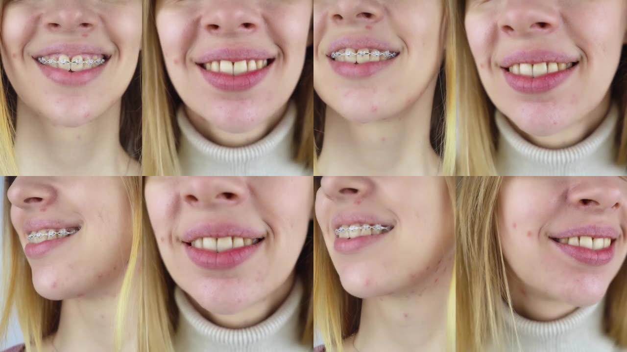 移除牙套之前和之后。左侧是金属支架系统中的女孩，右侧是手术后的直齿。矫正微笑和矫正牙齿的概念。特写