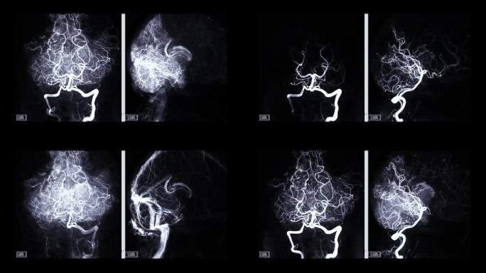 基底动脉脑血管造影。