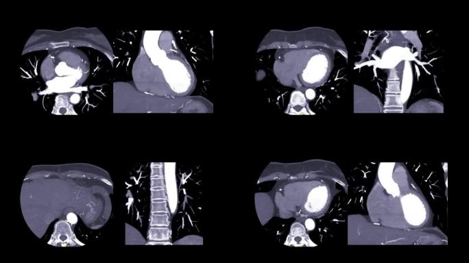 CTA冠状动脉。