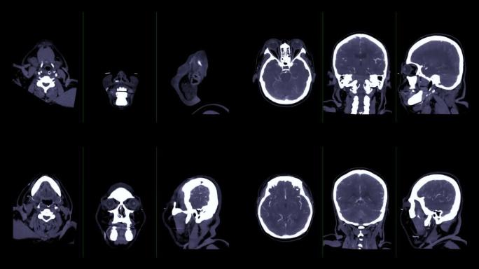 脑动脉ct血管造影术。