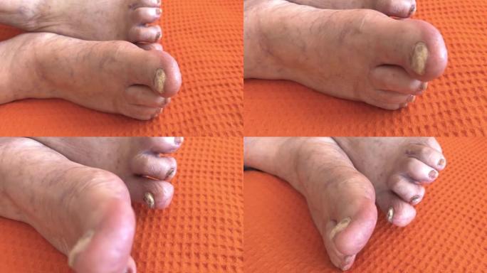 患有关节炎的老人脚部水肿，指甲损坏