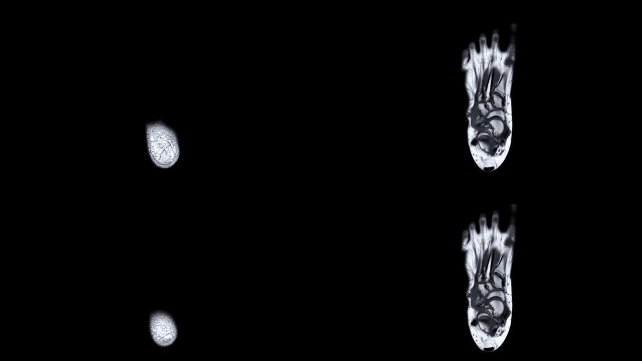 MRI足部扫描。