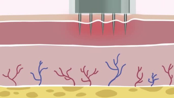 微针胶原蛋白诱导疗法，4k平板动画