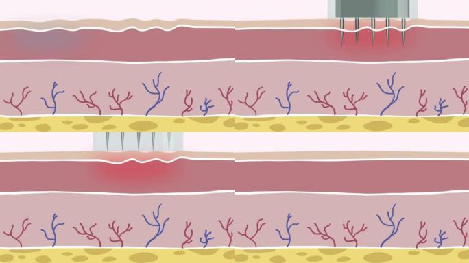 微针胶原蛋白诱导疗法，4k平板动画