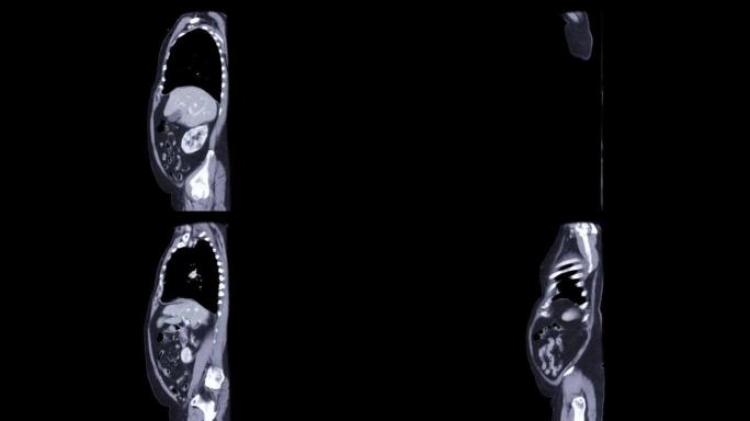 胸腹部ct扫描，注射造影剂。