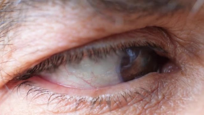 患有白内障的老人的眼睛，晶状体混浊，微距视频。