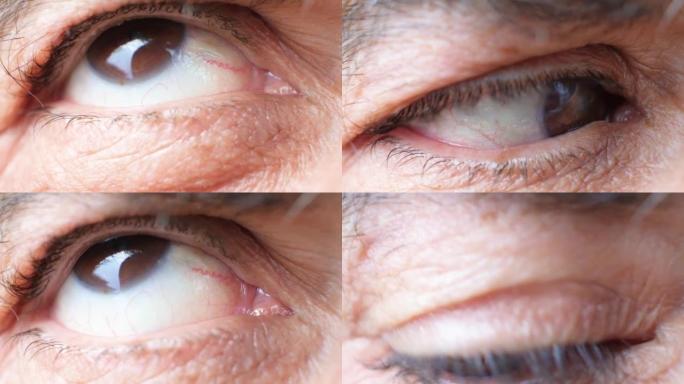 患有白内障的老人的眼睛，晶状体混浊，微距视频。