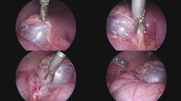 腹腔镜手术时腹腔内。