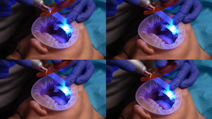 牙医在牙科诊所用紫外线灯将女性贴面和陶瓷冠固定在牙齿上